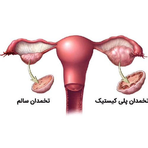 آیا قلیان باعث تنبلی تخمدان می شود؟